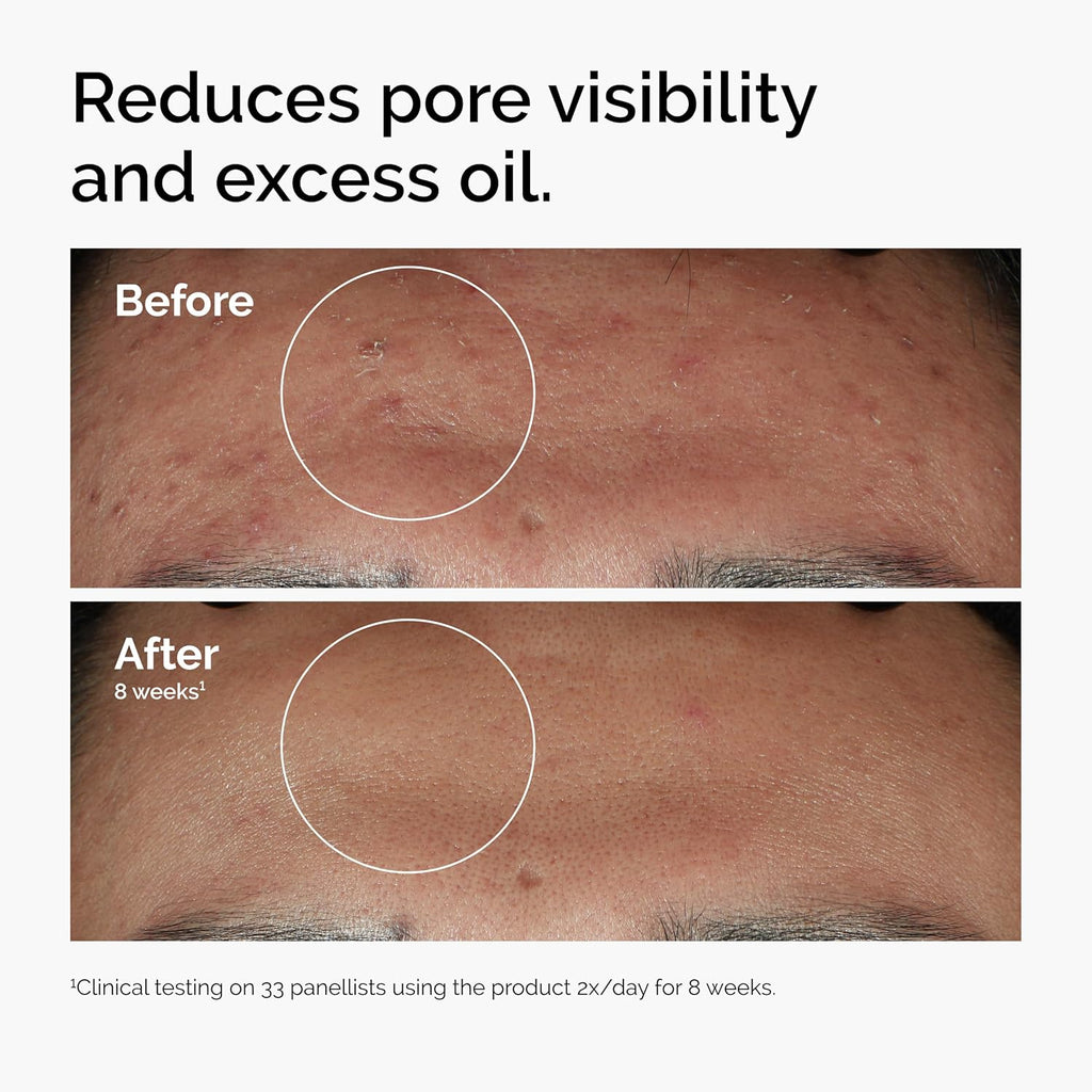 The Ordinary Niacinamide 10% + Zinc 1%, Smoothing Serum for Blemish-Prone Skin